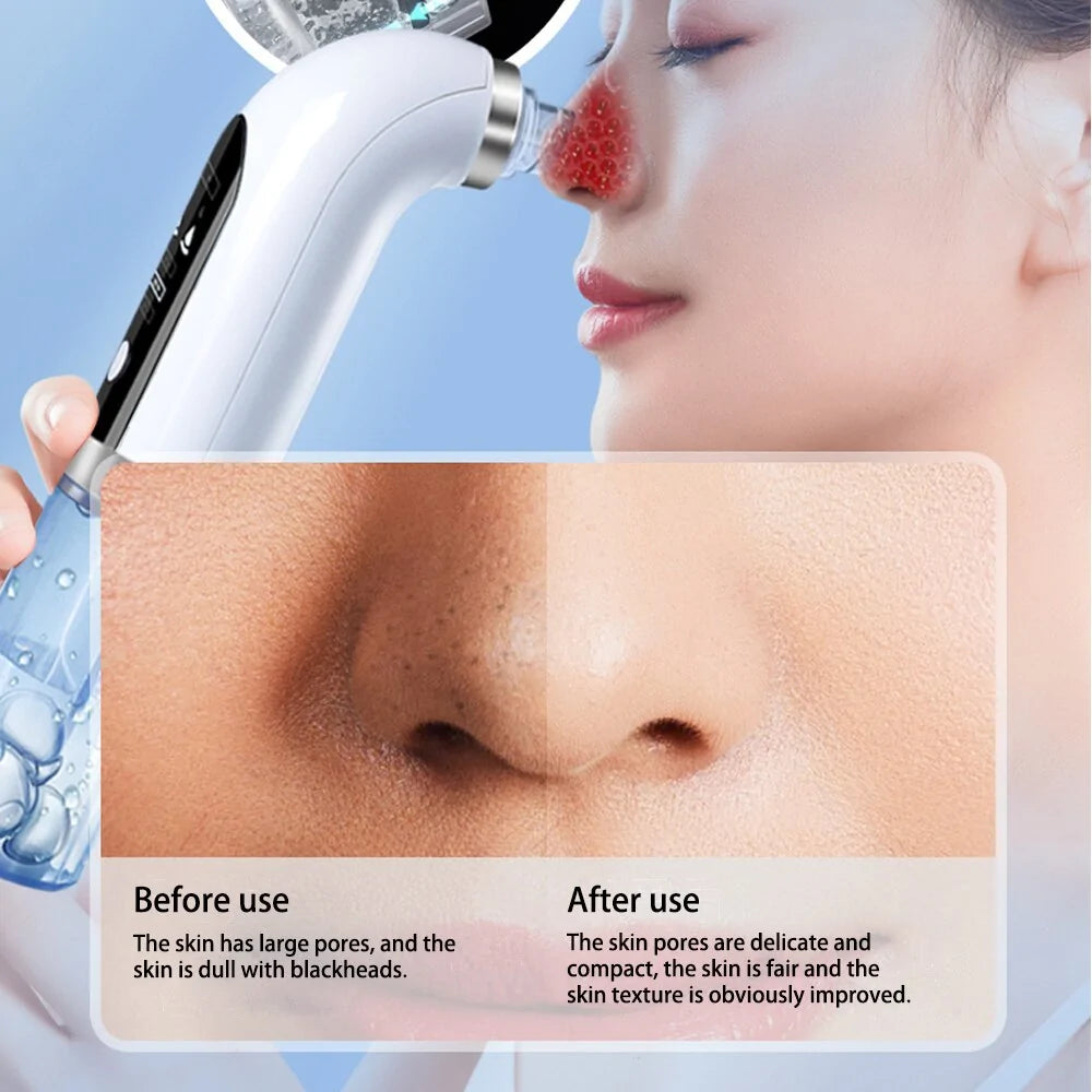 Blackhead Remover Device 